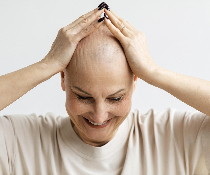 Regenerador Capilar - Alopecia Frontal