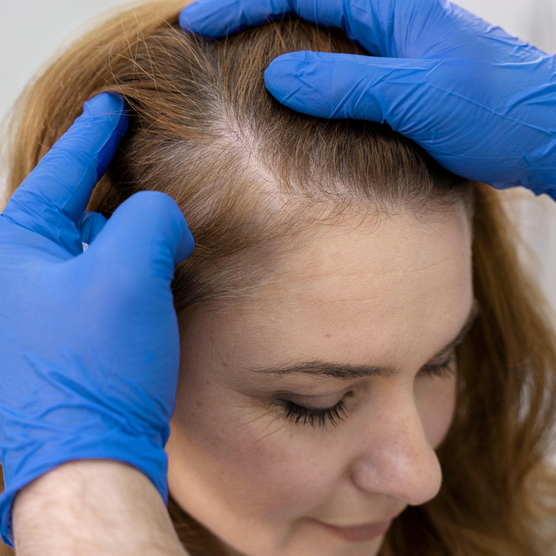 Regenerador Capilar - La alopecia femenina