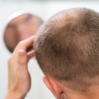 Tratamientos para la caída del cabello